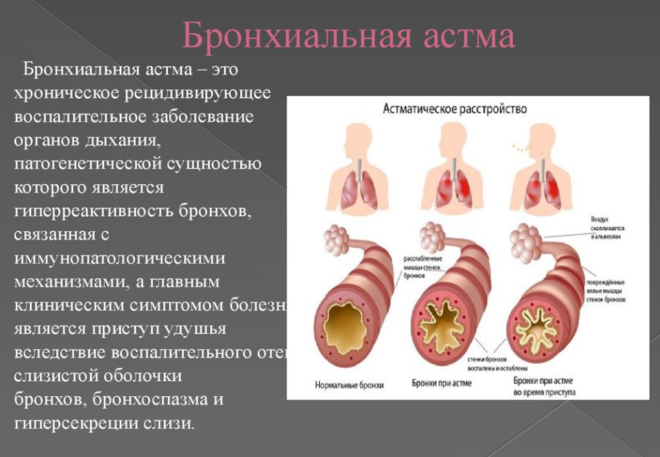 Бронхиальная астма является одной из важных причин бронхоспазма 