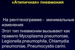 Атипичная пневмония
