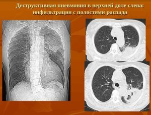 Деструктивное воспаление лёгких