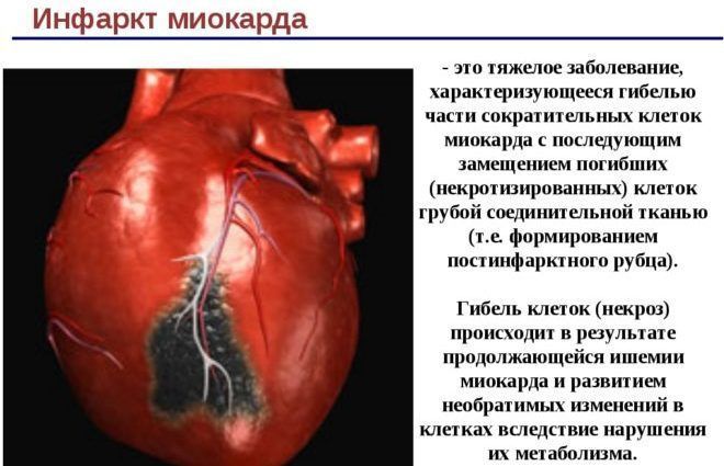 Инфаркт миокарда