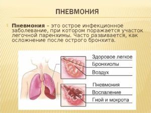 Ингаляция при пневмонии 