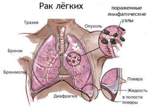 Рак лёгкого
