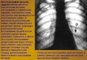 Рентгенограмма для диагностики пневмонии