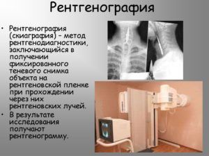 Рентгенография для диагностики пневмонии
