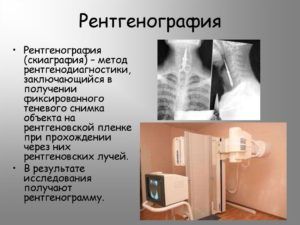 Рентгенография для выявления пневмонии
