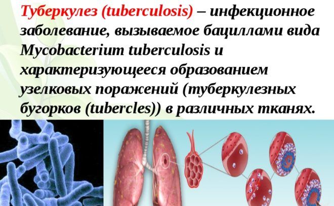 Туберкулёз