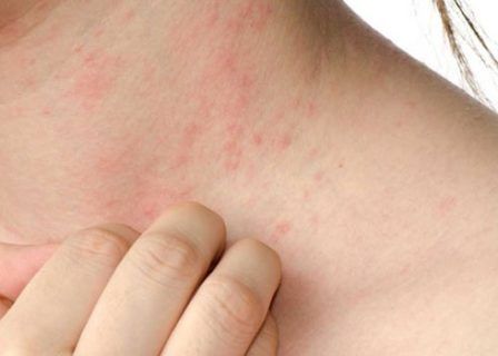 Аллергия в виде кожной сыпи
