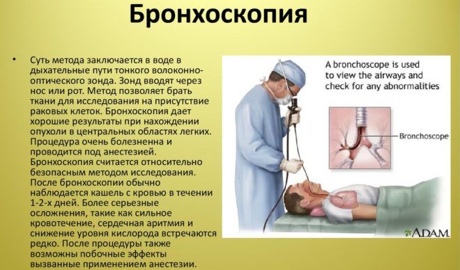 Бронхоскопия для диагностики бронхита