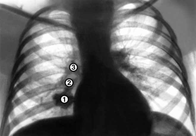 Очаги в лёгких на КТ: классификация образований