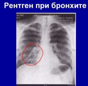 Признаки патологии на рентгеновском снимке