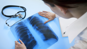 Рентген позволяет врачу внимательно рассмотреть состояние легких и поставить диагноз 