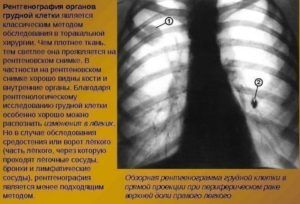 Рентгенография для диагностики пневмонии 