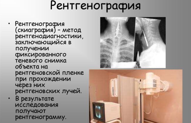 Рентгенография легких