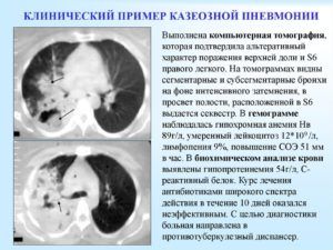 Виды казеозной пневмонии