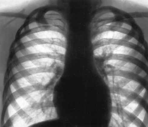 Рентген диффузного пневмофиброза