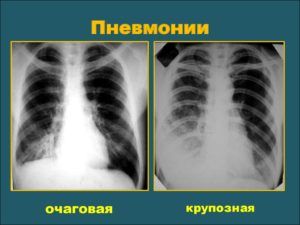Пневмонию на снимке флюорограммы
