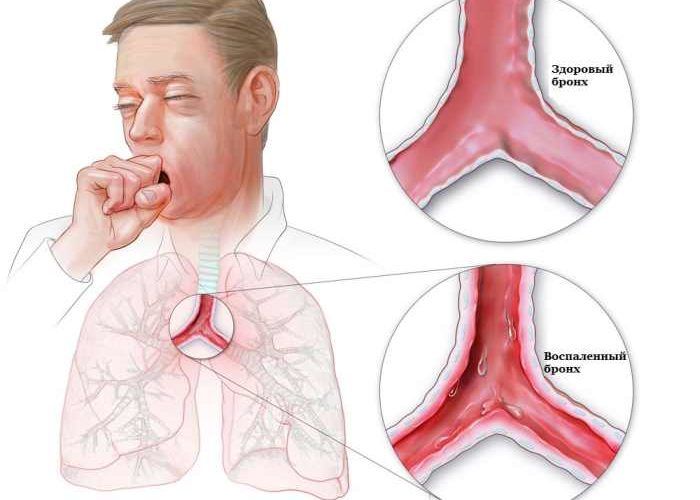 Хронические воспалительные и гнойные процессы дыхательной системы