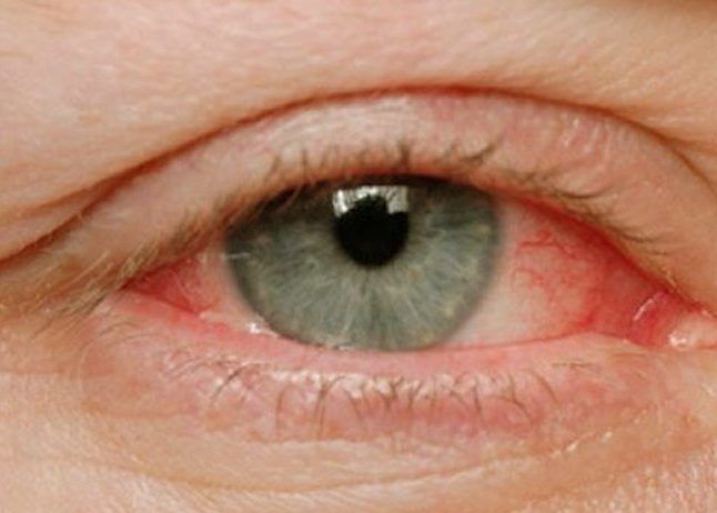 Покраснение глазных склер