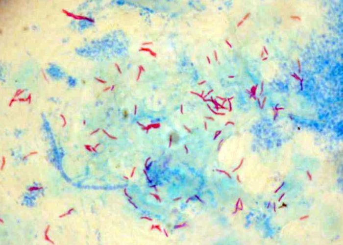 Наличие бактерий в мокроте