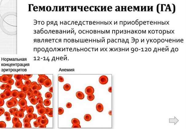 Гемолитической анеми