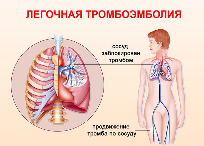 Инфаркт и тромбоэмболия легкого