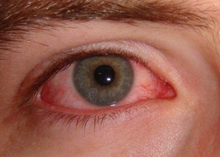 Инфекционное поражение слизистой глазной оболочки