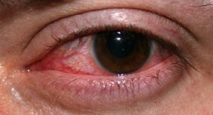 Пациентам с травмами глаза следует принимать по 2 капли