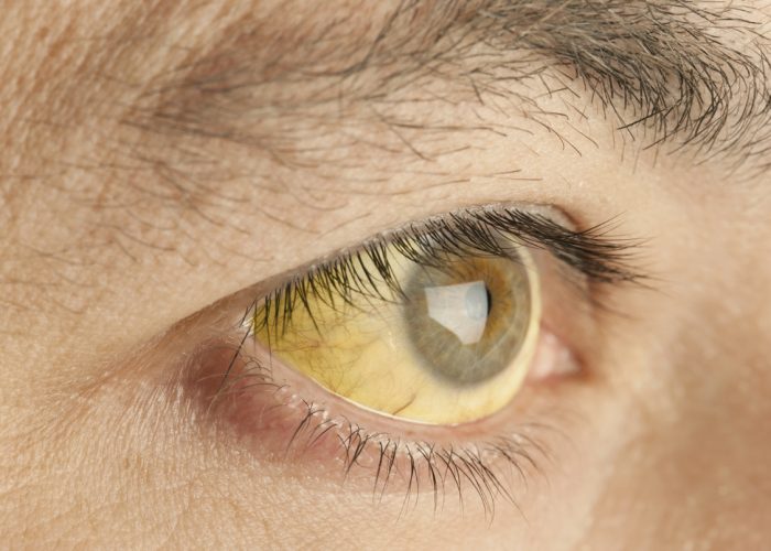 Пожелтение белков глаз