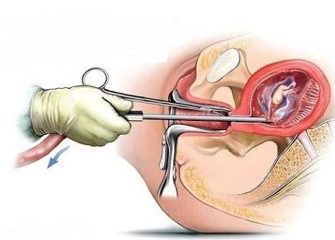 Проведение хирургического вмешательства матки при беременности