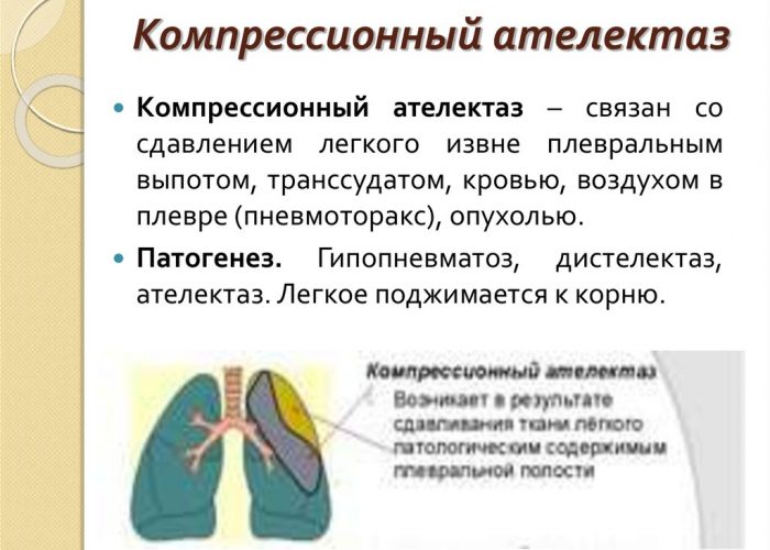 Ателектаз лёгких