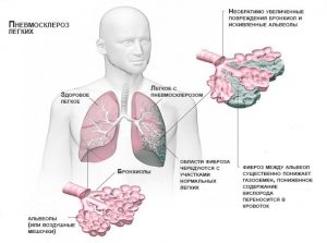 Симптомы пневмосклероза легких