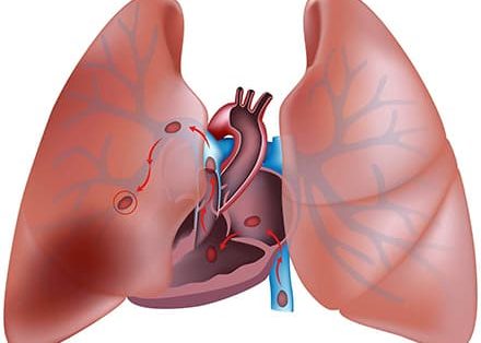 Тромбоэмболия лёгочной артерии